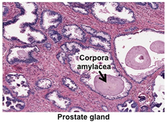 normal size prostate gland with concretions milyen csípő dysplasia betegség
